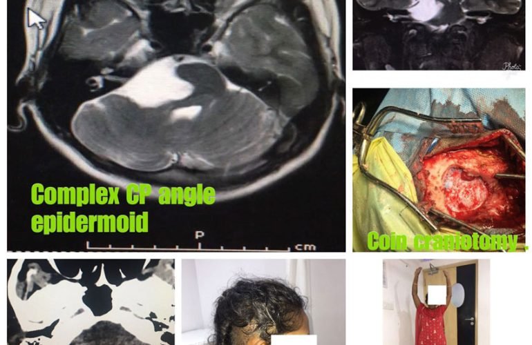 Complex CP Angle Epidermoid Surgery​