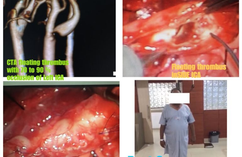 Cervical Laminoplasty for OPLL​